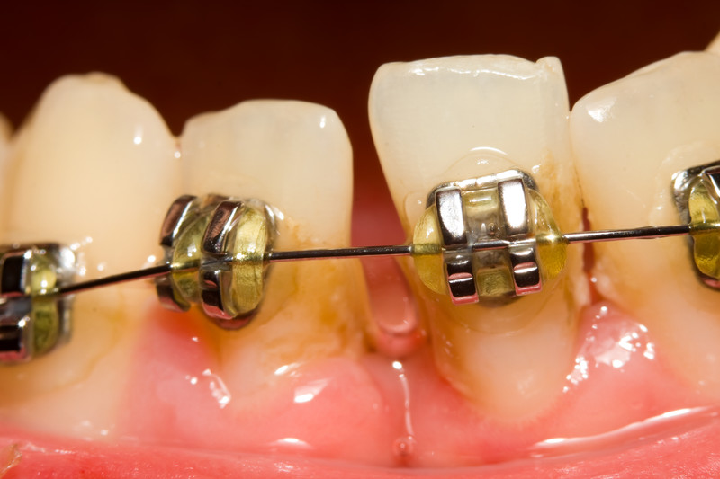 gapped teeth before and after braces