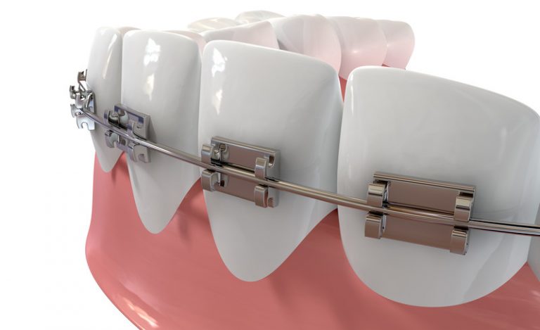 parts-of-braces-the-wire-portland-braces